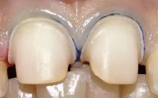 為什么備牙后需要拋光？  